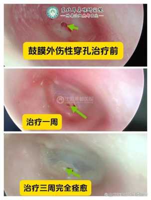 最新耳膜穿孔案例（耳膜穿孔根治）